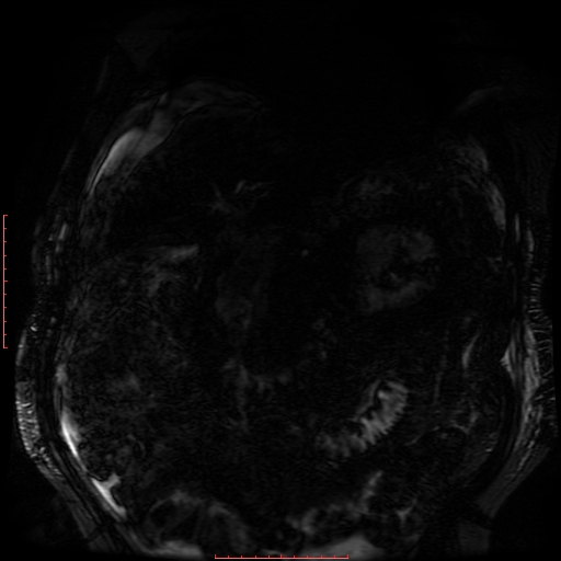 Acute necrotizing pancreatitis (Radiopaedia 28194-28448 Coronal MRCP 70).jpg