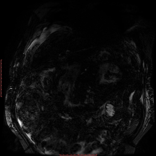 Acute necrotizing pancreatitis (Radiopaedia 28194-28448 Coronal MRCP 76).jpg