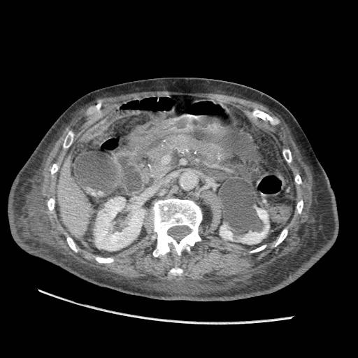 Acute on chronic pancreatitis (Radiopaedia 13233-13244 Axial C+ portal venous phase 41).jpg