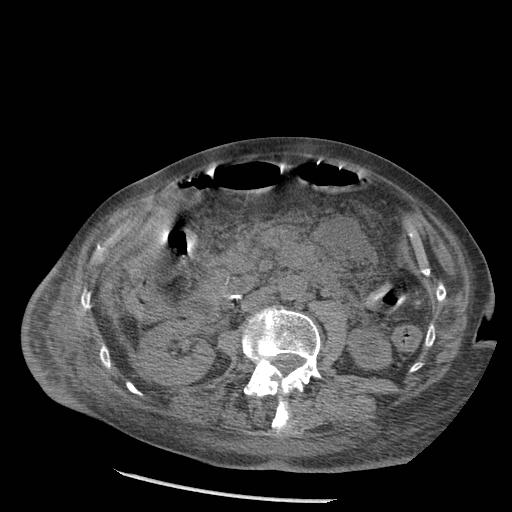 Acute on chronic pancreatitis (Radiopaedia 13233-13244 Axial non-contrast 48).jpg