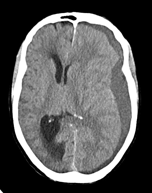Acute on chronic subdural hematoma (Radiopaedia 74814-85823 Axial non-contrast 46).jpg