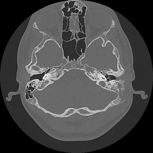 File:Acute otomastoiditis and Bezold abscess (Radiopaedia 88184-104786 Axial bone window 30).jpg