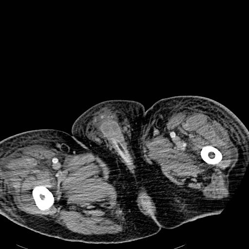 Acute pancreatic necrosis (Radiopaedia 13560-18501 Axial C+ portal venous phase 167).jpg