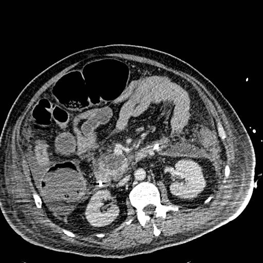 Acute pancreatic necrosis (Radiopaedia 13560-18501 Axial C+ portal venous phase 63).jpg
