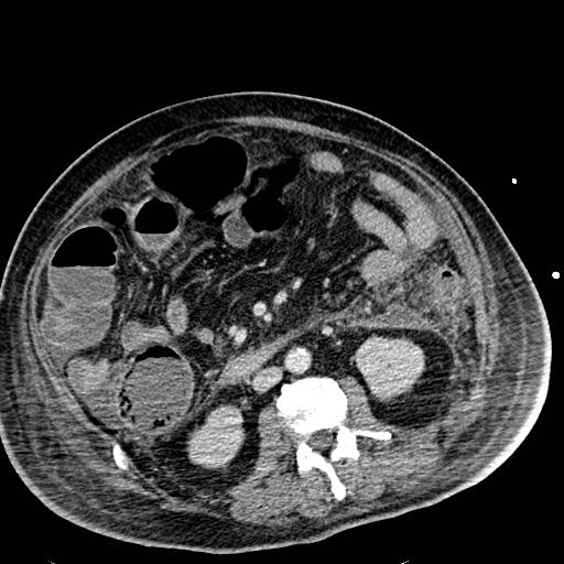 Acute pancreatic necrosis (Radiopaedia 13560-18501 Axial C+ portal venous phase 73).jpg