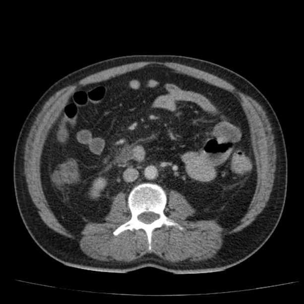 Acute pancreatitis (Radiopaedia 26663-26813 Axial C+ portal venous phase 47).jpg
