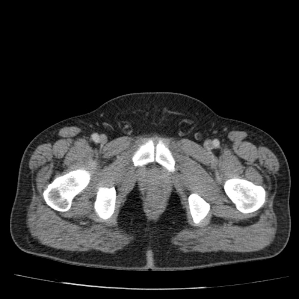 Acute pancreatitis (Radiopaedia 26663-26813 Axial C+ portal venous phase 89).jpg