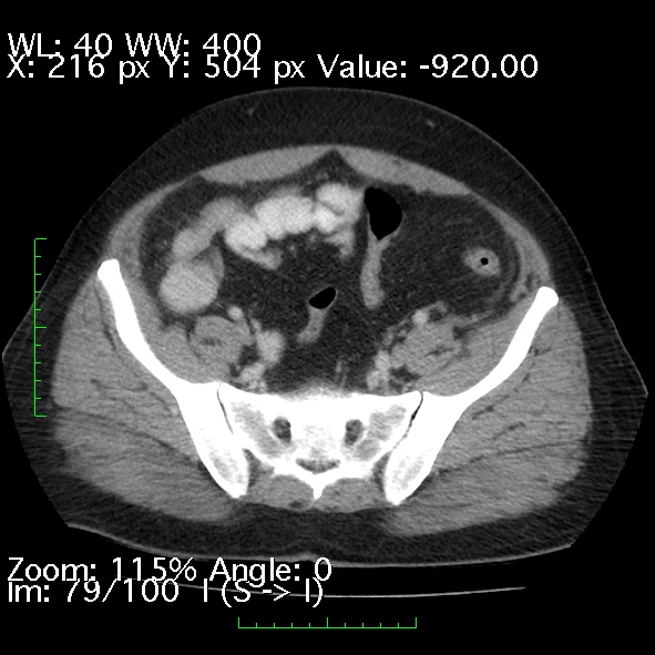 Acute pancreatitis (Radiopaedia 34043-35276 Axial C+ portal venous phase 79).jpg