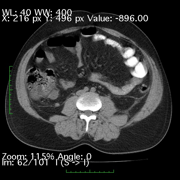 Acute pancreatitis (Radiopaedia 34043-35276 Axial non-contrast 62).jpg