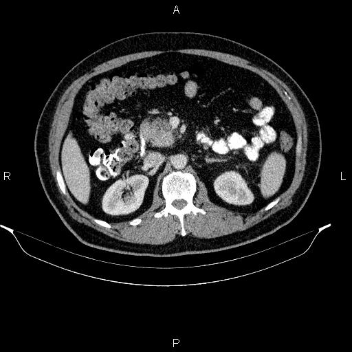 Acute pancreatitis (Radiopaedia 85390-101010 Axial C+ portal venous phase 41).jpg