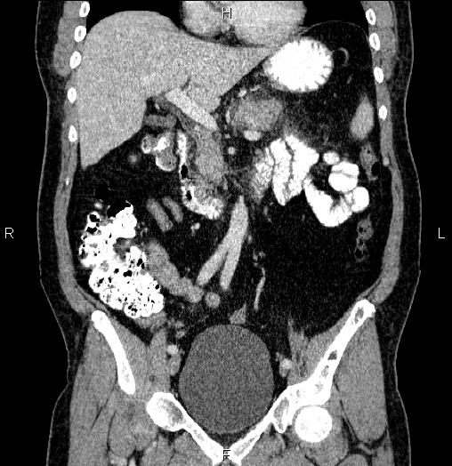 Acute pancreatitis (Radiopaedia 85390-101010 Coronal C+ portal venous phase 32).jpg