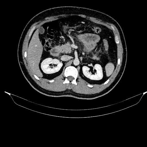 Acute pancreatitis (Radiopaedia 87428-103757 Axial C+ portal venous phase 39).jpg