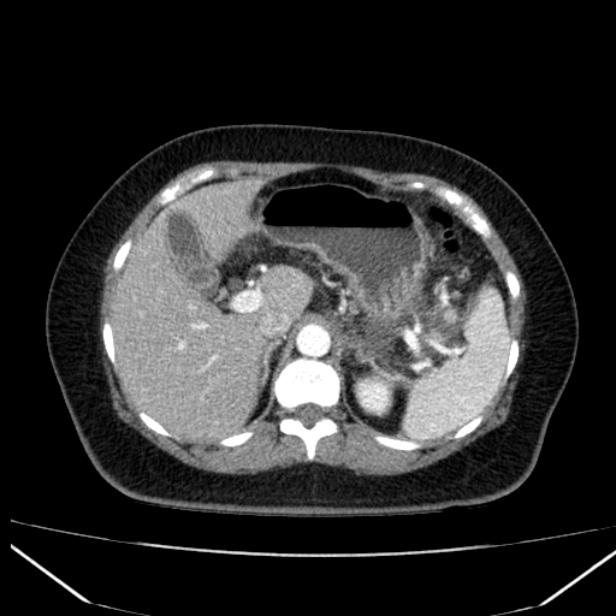 Acute pancreatitis - Balthazar C (Radiopaedia 26569-26714 Axial C+ arterial phase 24).jpg