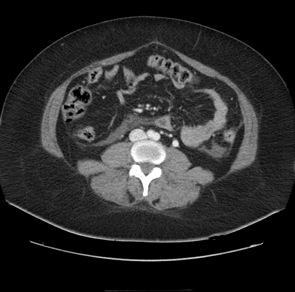 Acute pancreatitis - Balthazar E (Radiopaedia 29016-29377 Axial C+ portal venous phase 41).png