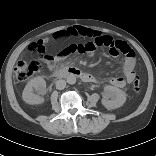 File:Acute pancreatitis and walled-off necrosis (Radiopaedia 29888-30404 Axial non-contrast 40).jpg