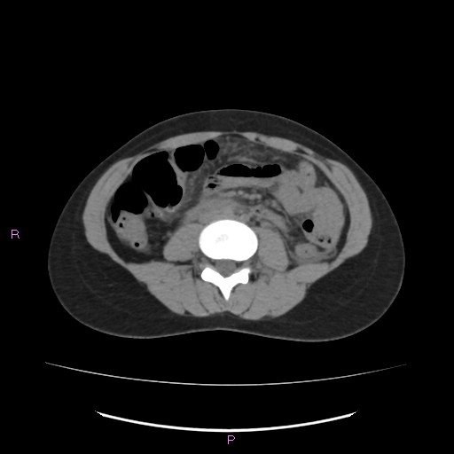Acute pancreatitis secondary to stone at minor papilla and pancreatic divisum (Radiopaedia 76570-88333 Axial non-contrast 40).jpg