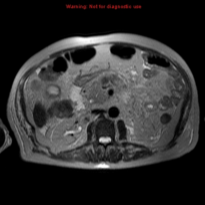 File:Acute pancreatitis with incidental pancreatic lipoma (Radiopaedia 10190-10732 Axial T2 5).jpg