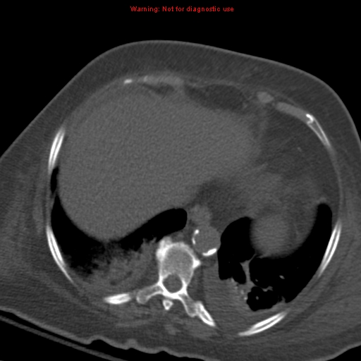 Acute pulmonary embolism (Radiopaedia 13286-13289 Axial C+ CTPA 55).jpg