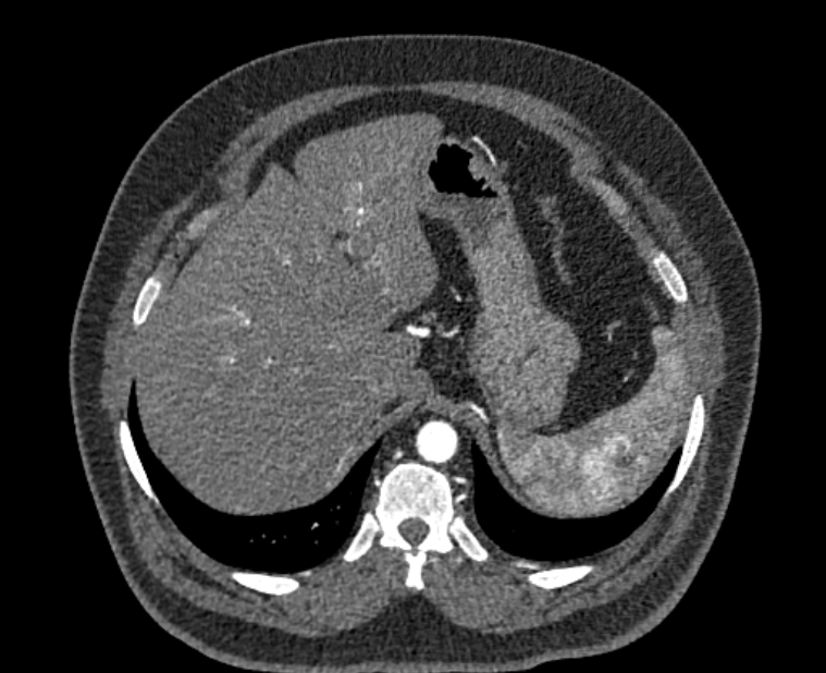 Acute pulmonary embolism with pulmonary infarcts (Radiopaedia 77688-89908 Axial C+ CTPA 66).jpg