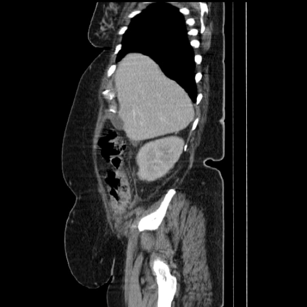 Acute pyelonephritis (Radiopaedia 25657-25837 Sagittal renal parenchymal phase 22).jpg