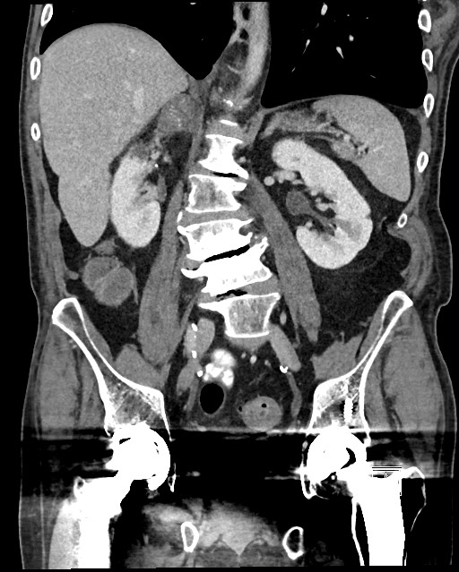 Acute renal infarction - rim capsular enhancement (Radiopaedia 59833-67270 Coronal C+ portal venous phase 35).jpg