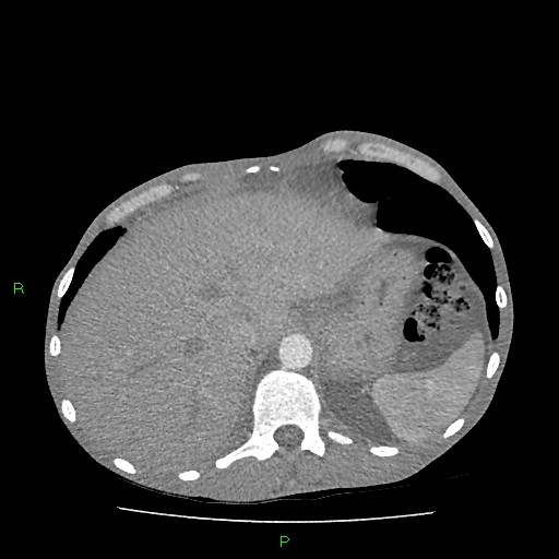 File:Acute right lung abscess (Radiopaedia 34806-36258 Axial C+ arterial phase 169).jpg