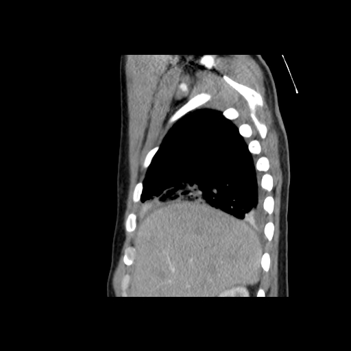 File:Acute segmental pulmonary emboli and pulmonary infarction (Radiopaedia 62264-70444 Sagittal C+ CTPA 15).jpg