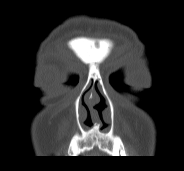 File:Acute sinusitis (Radiopaedia 23161-23215 Coronal bone window 20).jpg