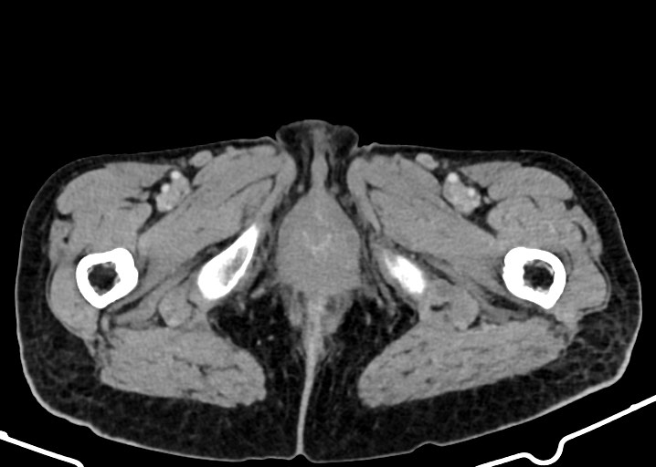 Acute small bowel (ileal) volvulus (Radiopaedia 71740-82139 Axial C+ portal venous phase 218).jpg
