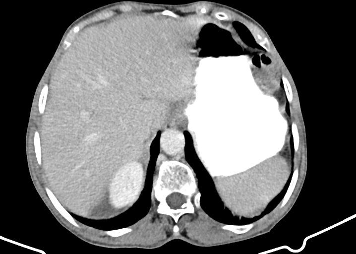 Acute small bowel (ileal) volvulus (Radiopaedia 71740-82139 Axial C+ portal venous phase 54).jpg