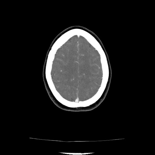 Acute subarachnoid hemorrhage and accessory anterior cerebral artery (Radiopaedia 69231-79009 Axial C+ arterial phase 115).jpg
