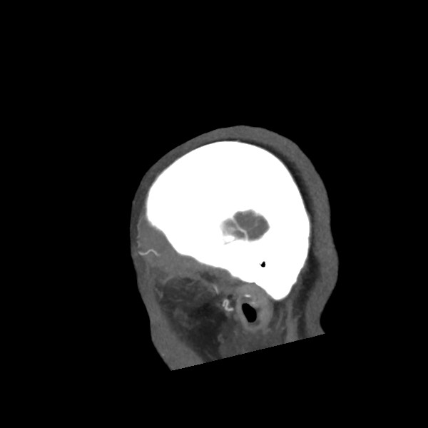 File:Acute subarachnoid hemorrhage and accessory anterior cerebral artery (Radiopaedia 69231-79009 Sagittal C+ arterial phase 8).jpg
