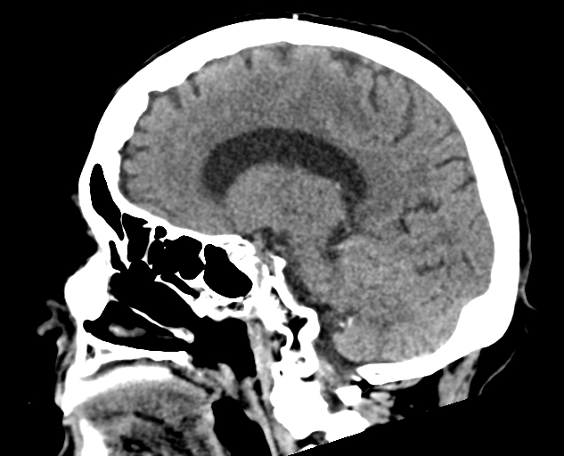 Acute traumatic subdural hematoma (Radiopaedia 82921-97257 Sagittal non-contrast 33).jpg