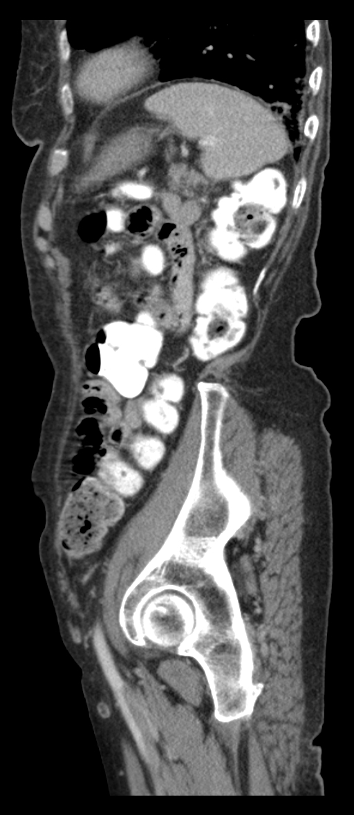 Adenocarcinoma of cecum (Radiopaedia 59222-66549 Sagittal C+ portal venous phase 14).jpg
