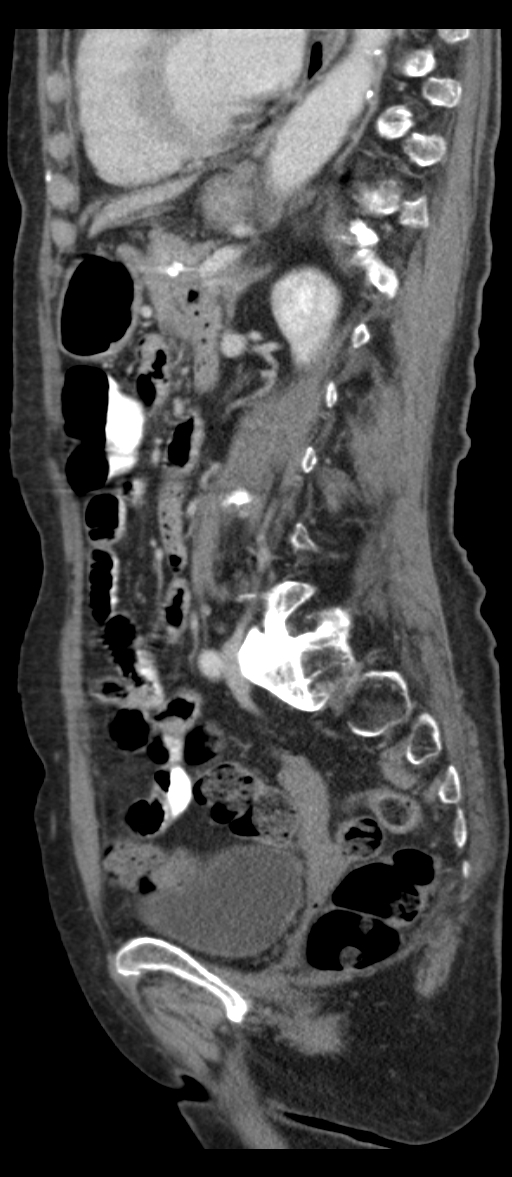 Adenocarcinoma of cecum (Radiopaedia 59222-66549 Sagittal C+ portal venous phase 34).jpg