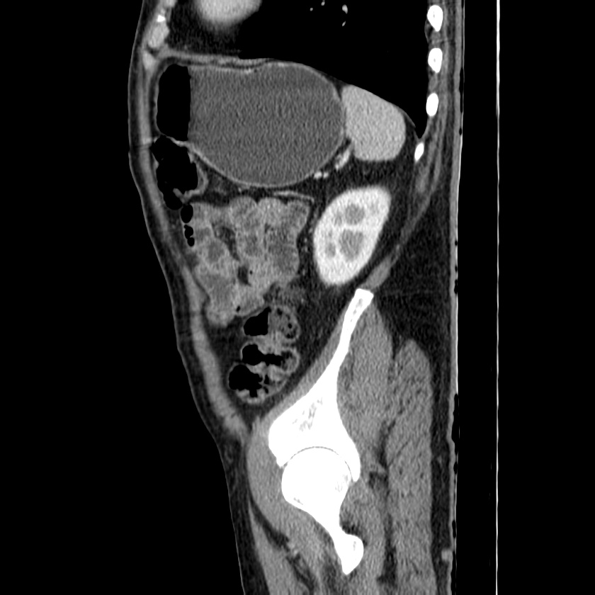 Adenocarcinoma of colon with entero-colic fistula (Radiopaedia 22832-22852 Sagittal C+ portal venous phase 52).jpg