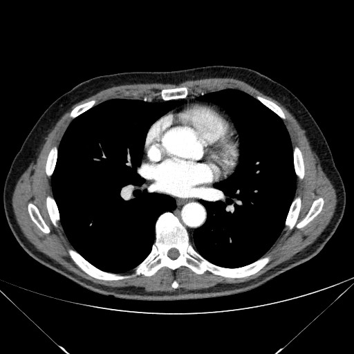 Adenocarcinoma of the lung (Radiopaedia 59871-67325 Axial C+ arterial phase 52).jpg