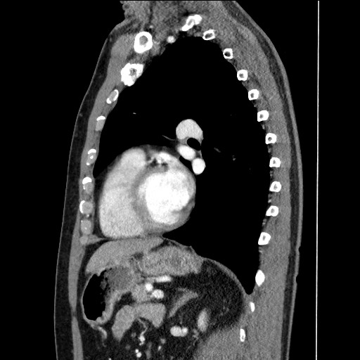 Adenocarcinoma of the lung (Radiopaedia 59871-67325 Sagittal C+ arterial phase 65).jpg