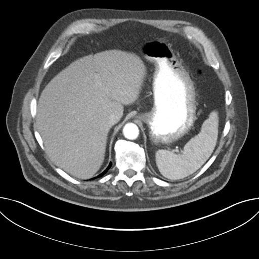 Adenocarcioma of rectum- T1 lesion (Radiopaedia 36921-38547 Axial C+ arterial phase 50).png