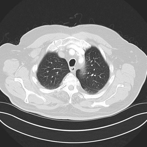 Adenocarcioma of rectum- T1 lesion (Radiopaedia 36921-38547 Axial lung window 15).png