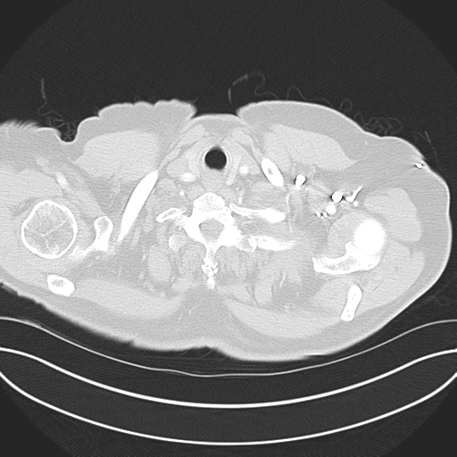 Adenocarcioma of rectum- T1 lesion (Radiopaedia 36921-38547 Axial lung window 5).png
