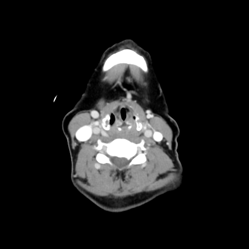 File:Adenoid cystic tumor of palate (Radiopaedia 46980-51518 Axial C+ delayed 48).png