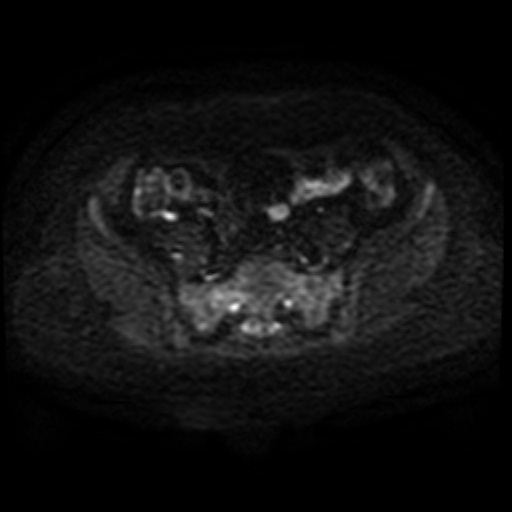 File:Adenoma malignum of cervix (Radiopaedia 66441-75705 Axial DWI 52).jpg