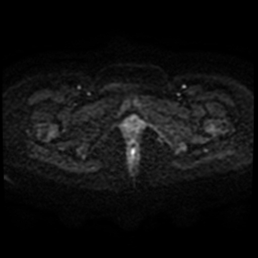 Adenoma malignum of cervix (Radiopaedia 66441-75705 Axial DWI 74).jpg