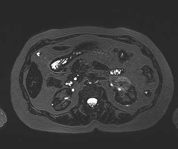 File:Adenomyomatosis of the gallbladder (Radiopaedia 50246-55587 Axial 26).png