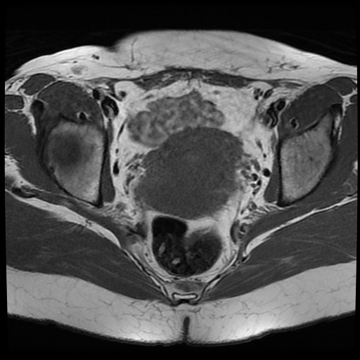 File:Adenomyosis-scar endometriosis (Radiopaedia 65863-75022 Axial T1 19).jpg