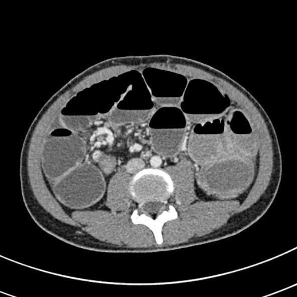 Adhesional small bowel obstruction (Radiopaedia 52107-57980 Axial C+ portal venous phase 67).jpg