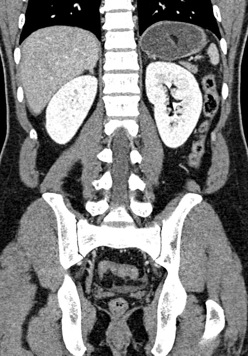 Adhesional small bowel obstruction (Radiopaedia 58900-66131 Coronal C+ portal venous phase 181).jpg