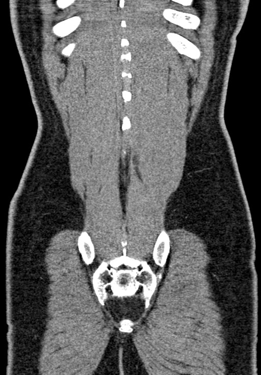 Adhesional small bowel obstruction (Radiopaedia 58900-66131 Coronal C+ portal venous phase 218).jpg