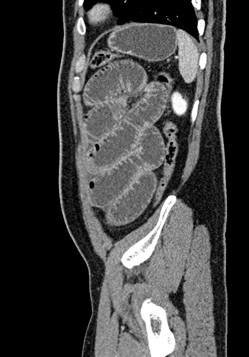 Adhesional small bowel obstruction (Radiopaedia 58900-66131 Sagittal C+ portal venous phase 208).jpg